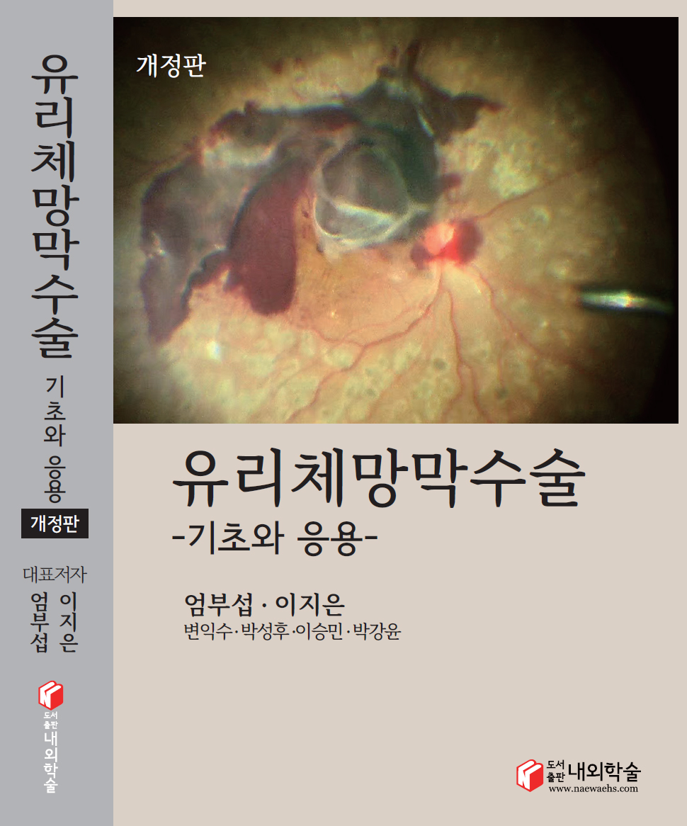 유리체망막수술 기초와응용